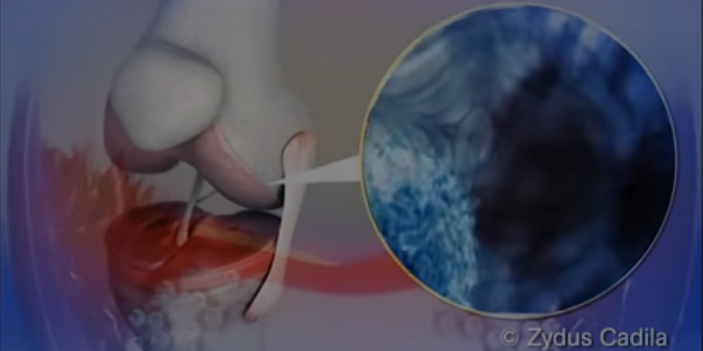 Adalimumab Injection