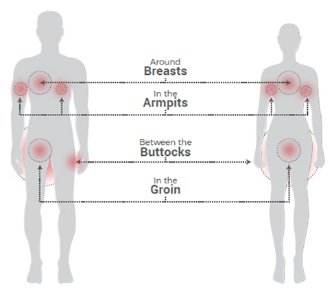 Hidradenitis Suppurativa Treatment