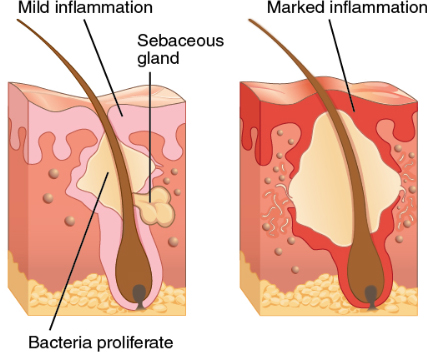 What causes Hidradenitis Suppurativa Signs & Symptoms